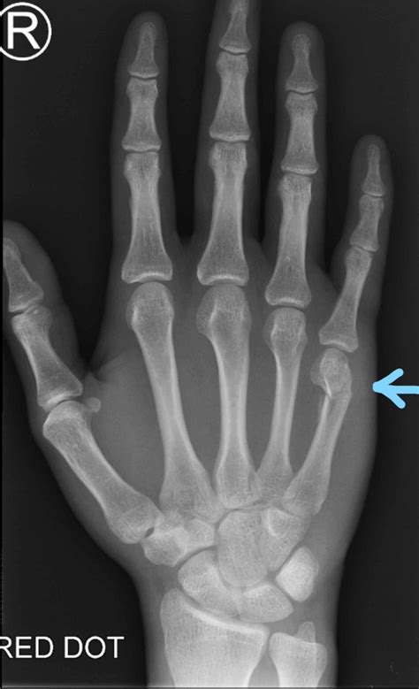 boxer's fracture metal plate|displaced boxers fracture.